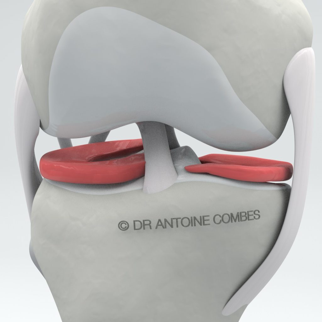 Chirurgie du Ménisque - DR ANTOINE COMBES