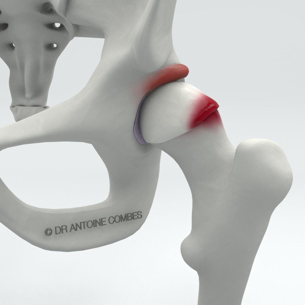 conflit-femoroacetabulaire