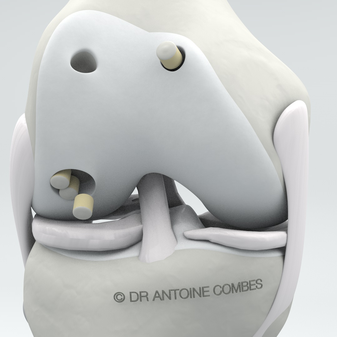 Greffe Cartilagineuse - DR ANTOINE COMBES