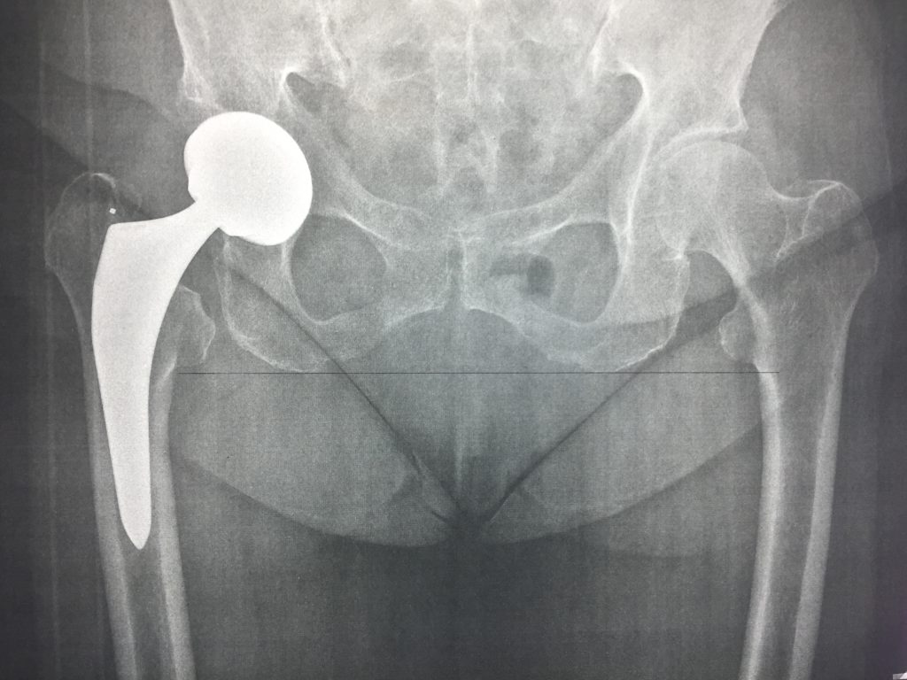 Radiographie d'une prothèse de hanche