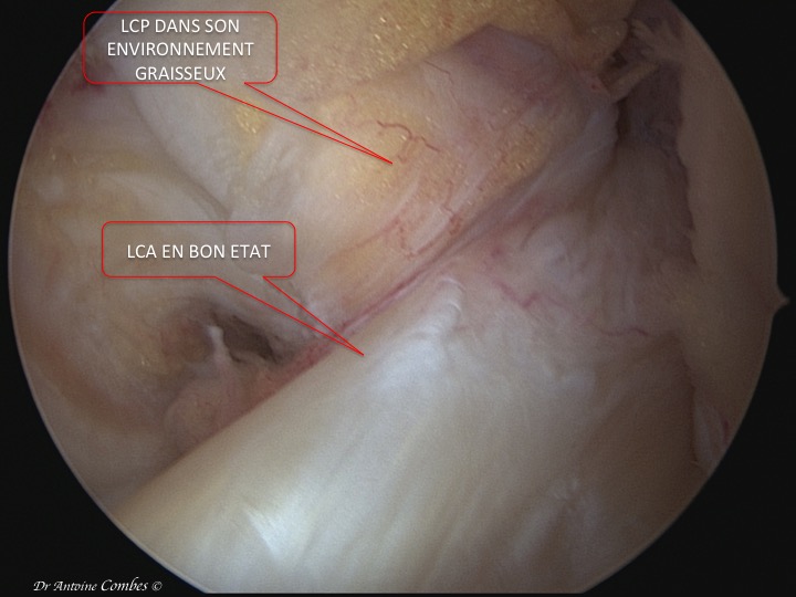 LCA normal. Vue arthroscopique