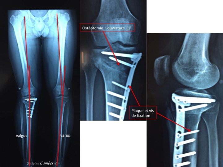Ostéotomie Tibiale de Valgisation - OTV - DR ANTOINE COMBES