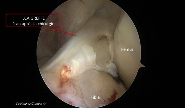  LCA greffé, 1 an après la chirurgie. Vue arthroscopique