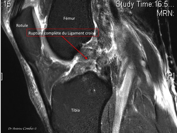 IRM d'une rupture du LCA, Les fibres sont completement désorganisées