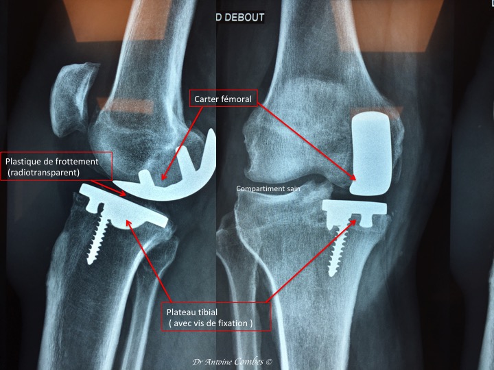 Radiographie Prothèse unicompartimentale  (PUC) interne