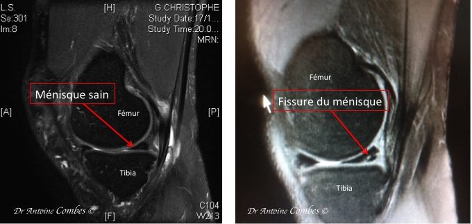 Chirurgie du Ménisque - DR ANTOINE COMBES