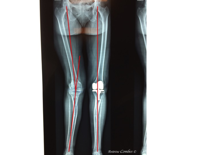 réaxation du membre par la prothèse totale de genou