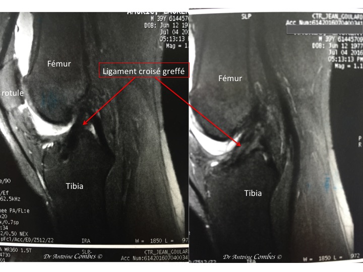 LCA greffé, 1 an après la chirurgie. Aspect IRM