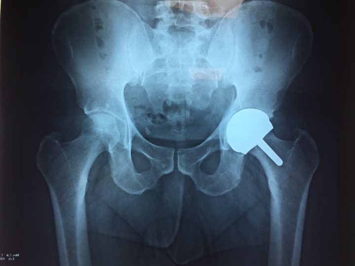 Radiographie d'un resurfaçage de hanche à droite Radiographie d'un resurfaçage de hanche à droite