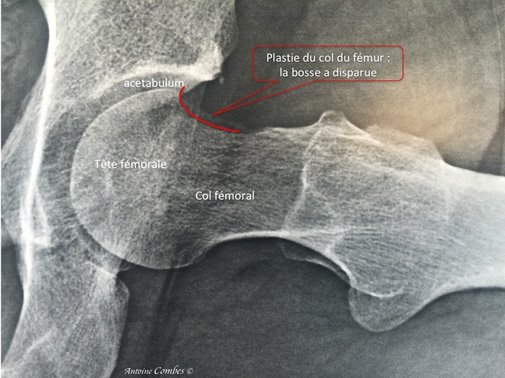 Radiographie d'une plastie du col fémoral