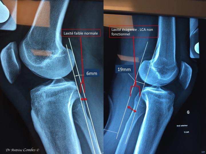 Laxité ( le "tiroir antérieur" d'un genou sain et d'un genou présentant une rupture ancienne de LCA. Radiographie dynamique.  13 mm de diffrentiel, c'est important, le risque d'instabilité est majeur.