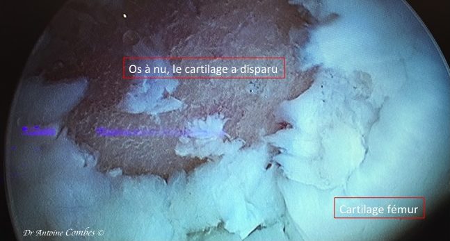 délamination du cartilage. Vue arthroscopique délamination du cartilage. Vue arthroscopique