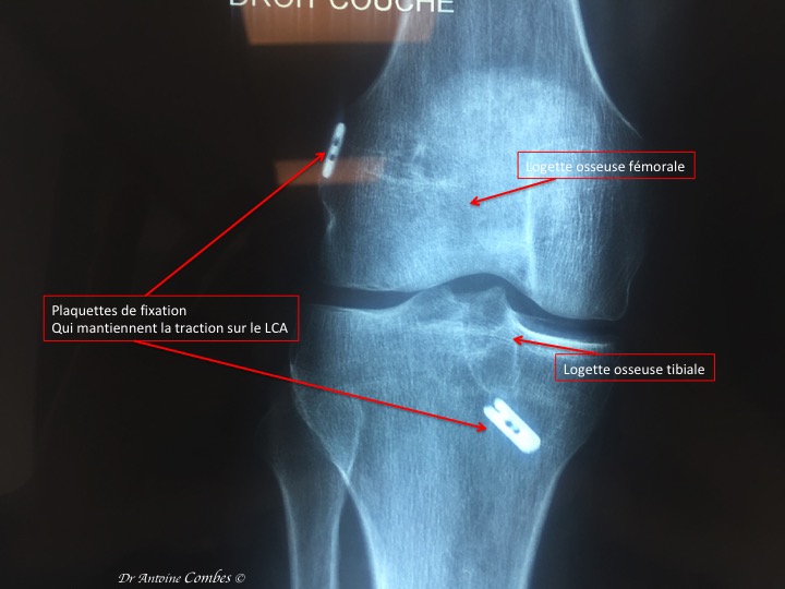 Radiographie d'un LCA greffé