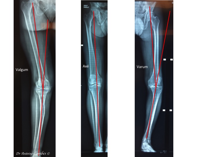 Radiographie des différentes déformation du membre