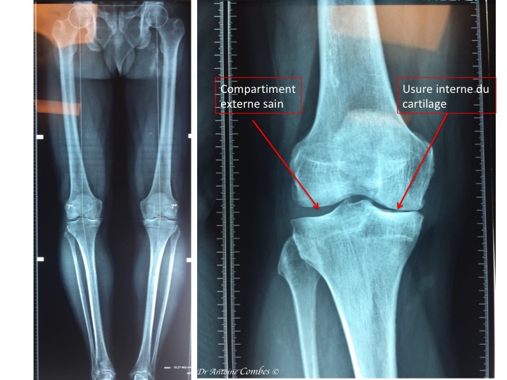 Radiographie d'une usure unicompartimentale