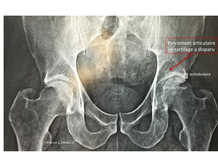 Radiographie de l'arhrose de la hanche gauche d'un sujet jeune