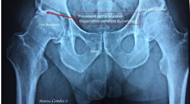 Arthrose de la hanche droite. La tête frotte dans la cavité acetabulaire comme une pierre.