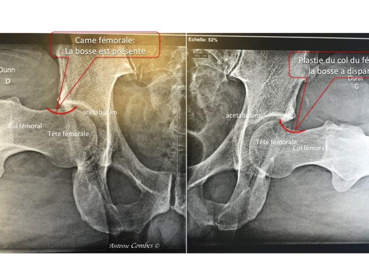 Radiographie comparative d'un col avec petite bosse, avant chirurgie vs d'une plastie de col aprés chirurgie 