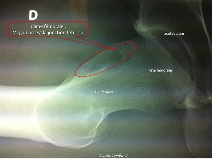 Bosse antérieure sur le col du fémur, responsable d'un conflit avec l'acétabulum : effet came