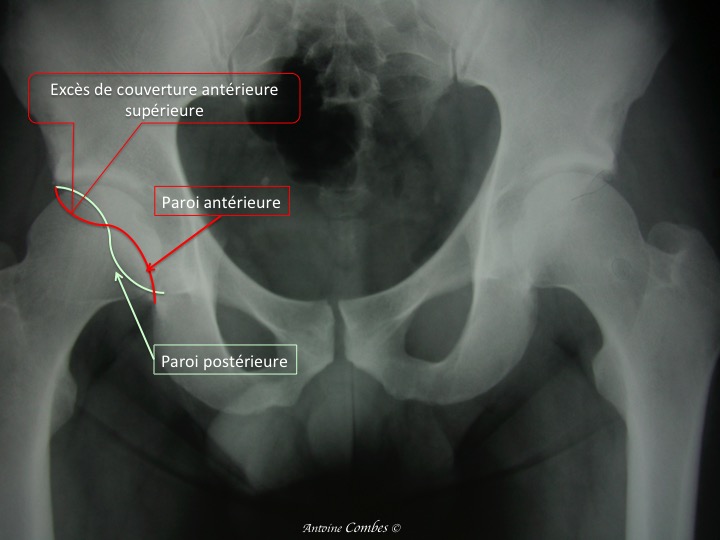 Hypecouverture antérieure de l'actebulum responsable d'un conflit avec le col du fémur : effet tenaille
