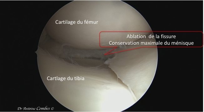 Ablation toute partielle du ménsique. Vue arthroscopique