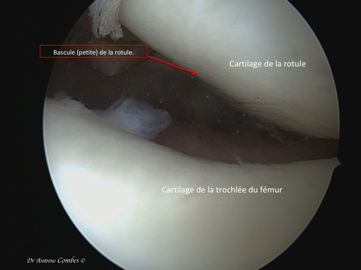 Bascule modérée de rotule . Vue arthroscopique