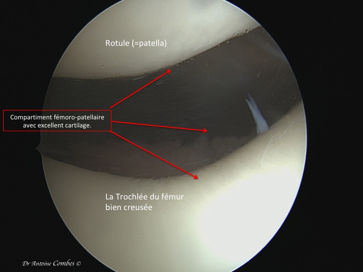 compratiment entre la trochlée du femur et la rotule. Vue arthroscopique.