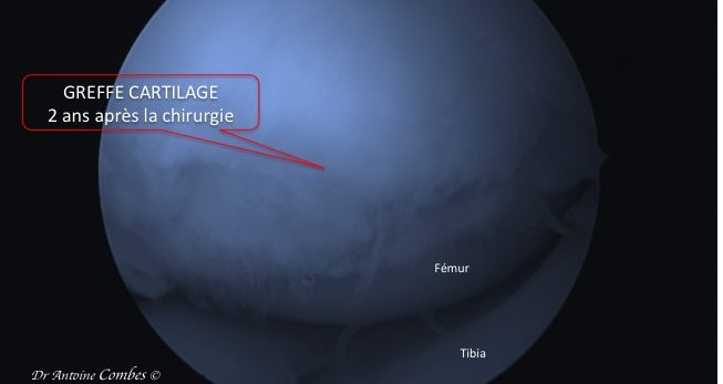 greffe cartilage 2 ans après la chirurgie. Vue arthroscopique. greffe cartilage 2 ans après la chirurgie. Vue arthroscopique.