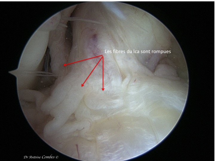 LCA rompu. Vue arthroscopique.