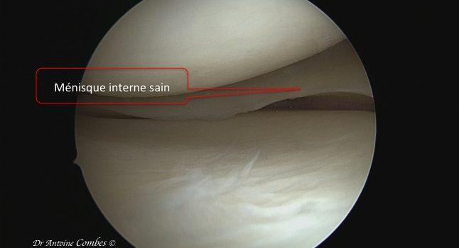 ménisque interne sain