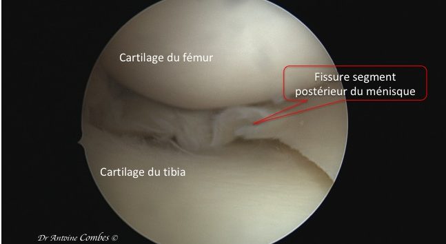 Fissure méniscale. Vue arthroscopique.