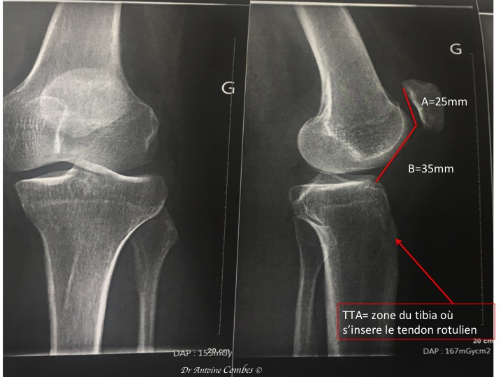 Radiographie d'une "rotule haute" : A/B>1,2