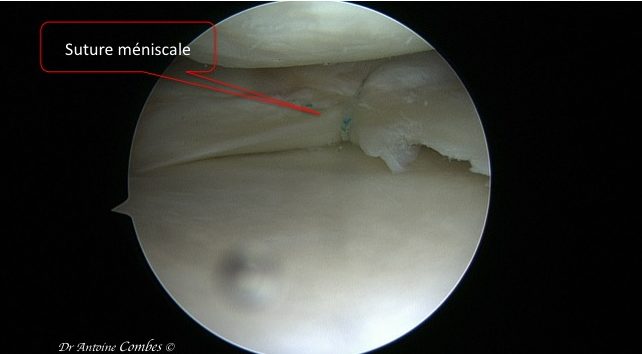 Suture méniscale. Vue arthroscopique