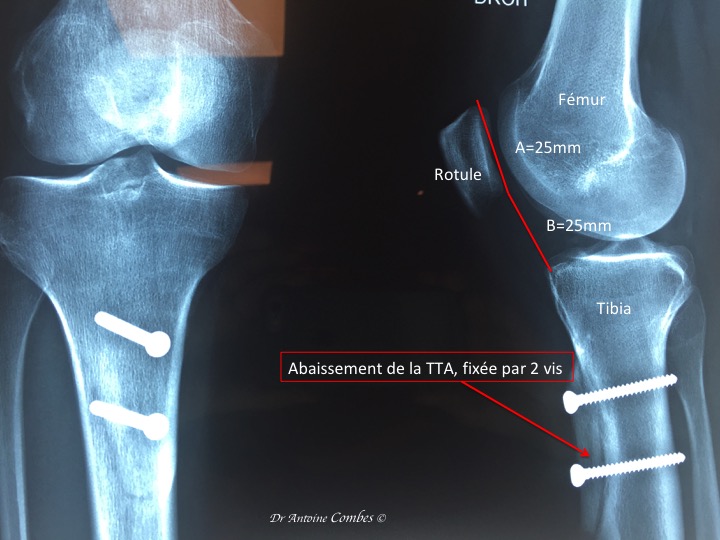 Abaissement de la Tuberosité tibiale antérieure (TTA) . Cela tire sur le tendon rotulien, donc sur la rotule, ainsi elle s'engage mieux dans le rail de la trochlée