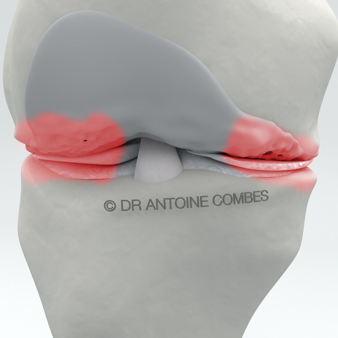 Arthrose = usure du cartilage, ici entre le fémur et le tibia